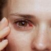 Vírus da catapora aumenta contaminações no Brasil: entenda o herpes-zóster