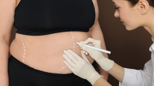 Cirurgia bariátrica