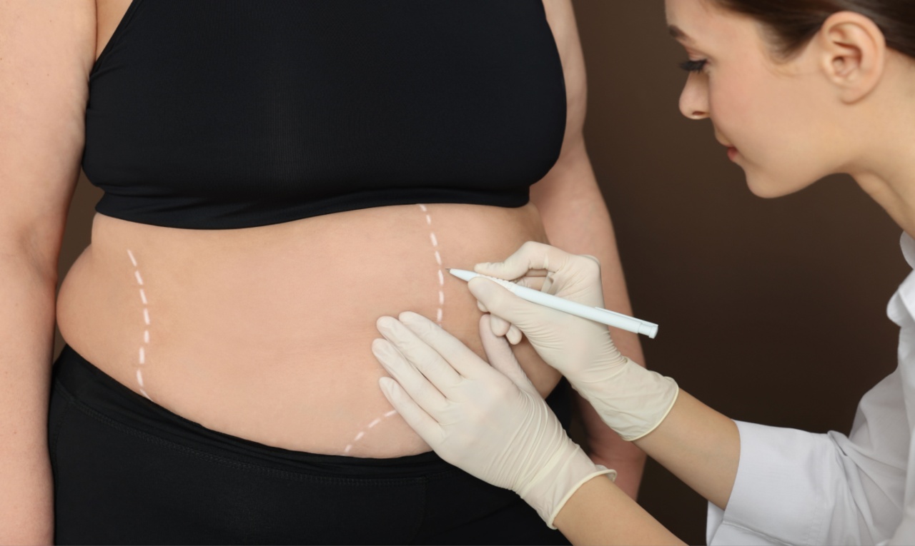 Cirurgia bariátrica