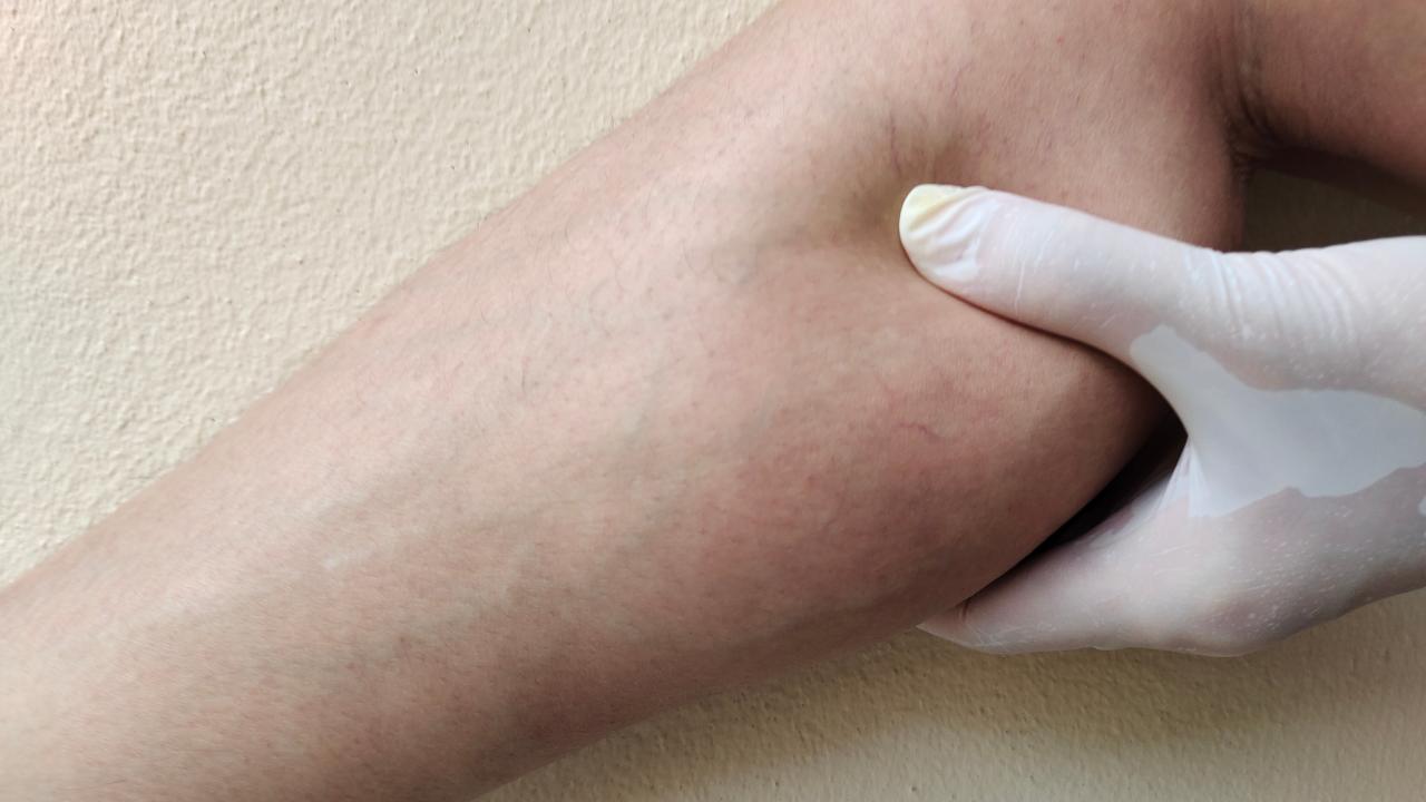 Mão com luva médica pressionando a região da panturrilha de uma pessoa, evidenciando sensibilidade e acúmulo de gordura característicos do lipedema
