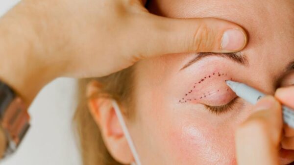 Blefaroplastia: entenda detalhes da cirurgia feita por Leonardo