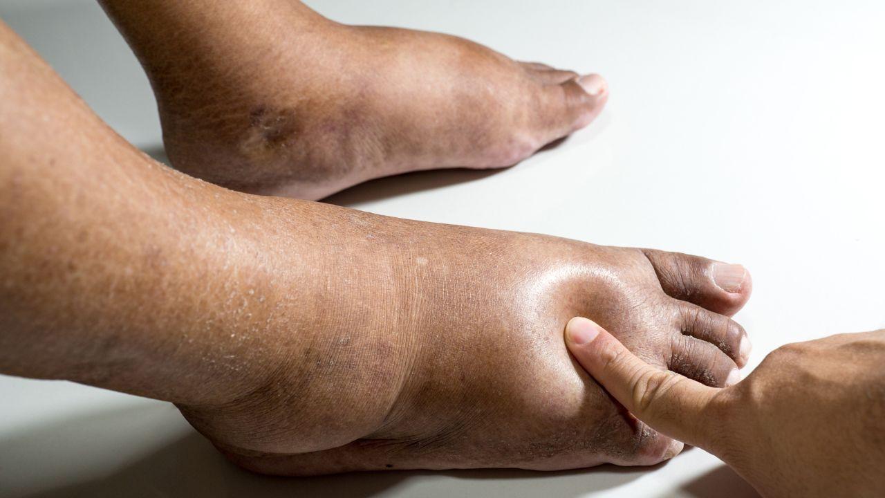 Imagem de dois pés bastante inchados