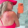 Fotografia da queimadura da tenista