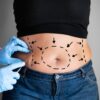 Abdominoplastia pode corrigir alterações musculares e melhorar dores e postura