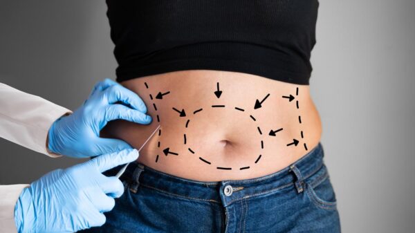 Abdominoplastia pode corrigir alterações musculares e melhorar dores e postura