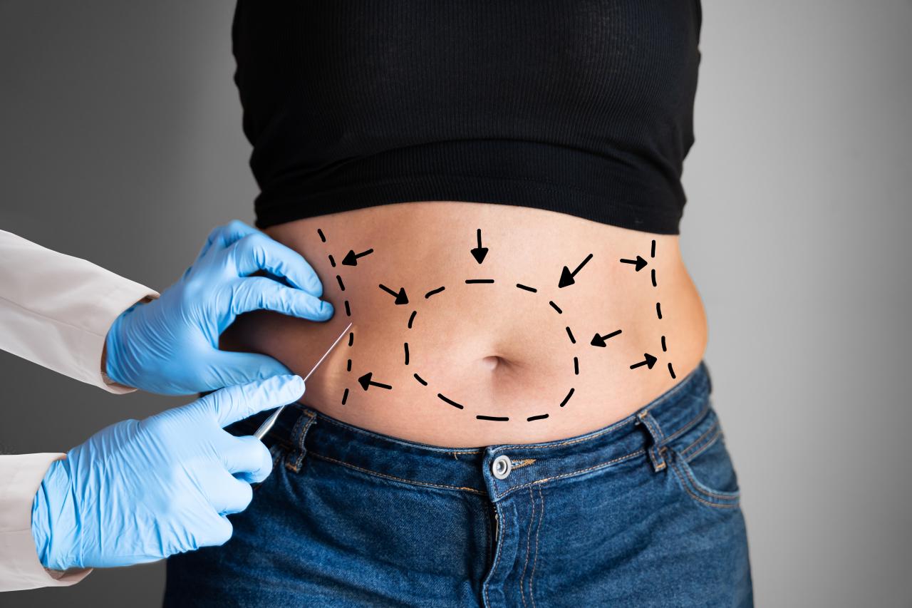 Abdominoplastia pode corrigir alterações musculares e melhorar dores e postura