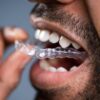 Imagem de um homem colocando alinhador transparente nos dentes