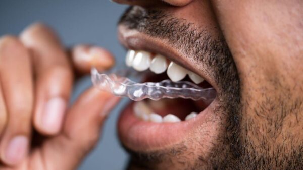 Imagem de um homem colocando alinhador transparente nos dentes