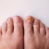 Alterações nas unhas podem ser sinais importantes sobre a saúde do corpo