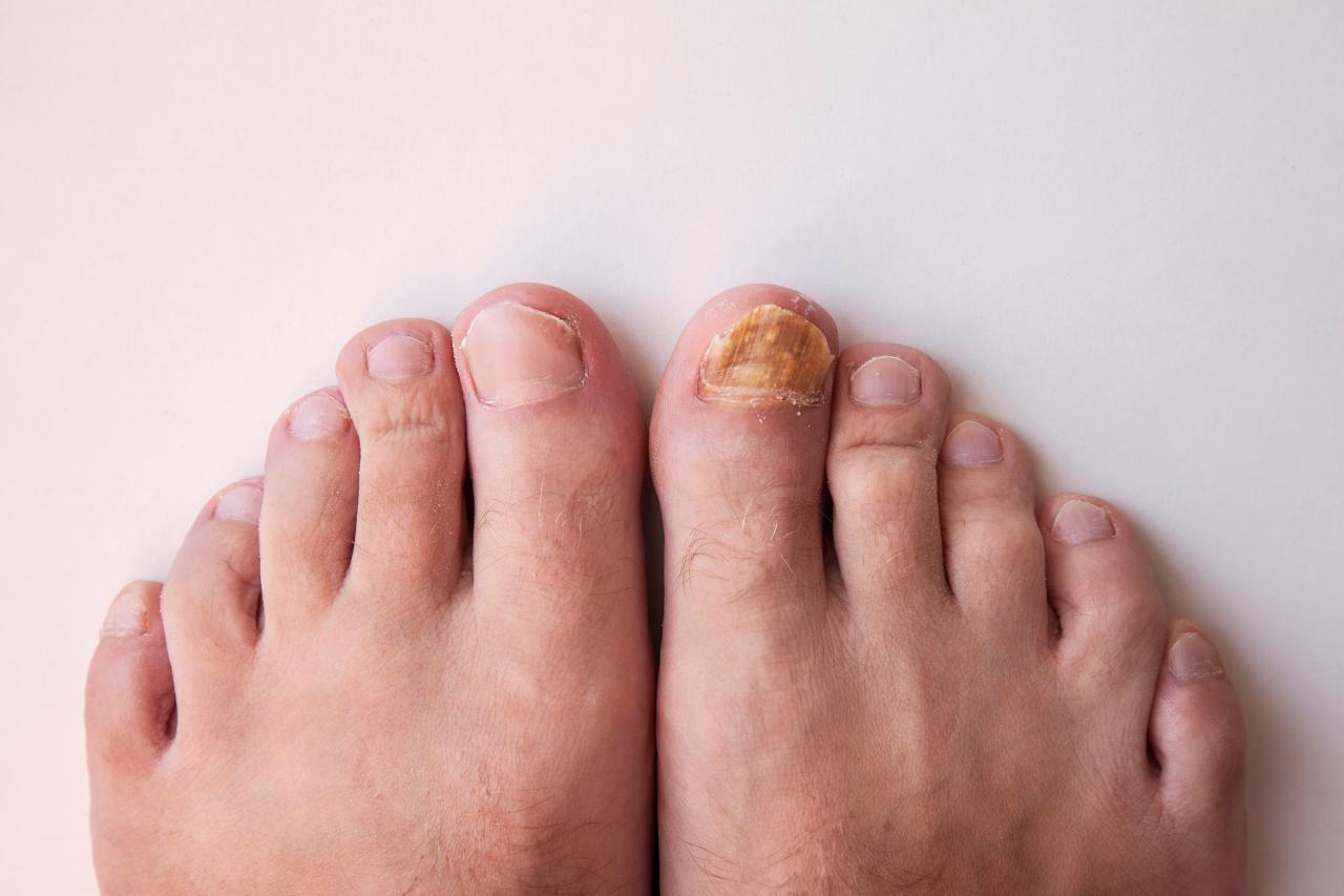 Alterações nas unhas podem ser sinais importantes sobre a saúde do corpo