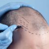 Imagem de uma cabeça calva sendo marcada para fazer tratamento