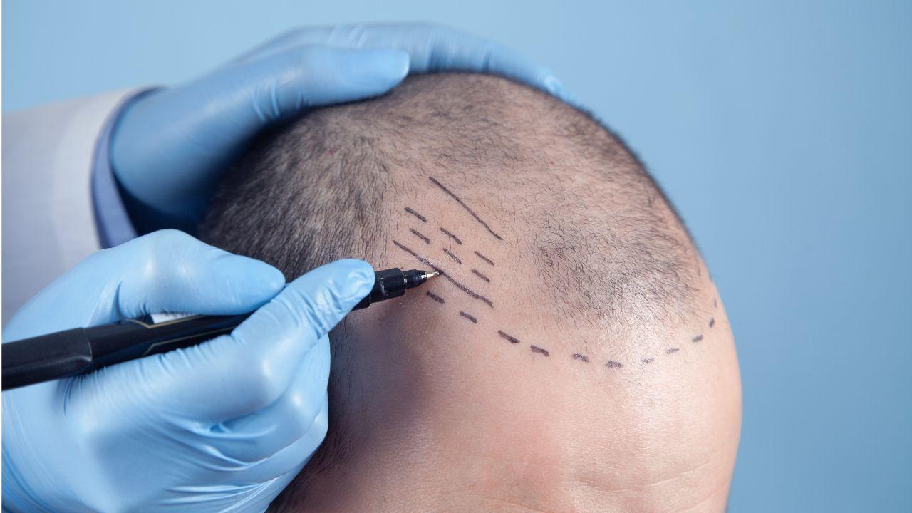 Imagem de uma cabeça calva sendo marcada para fazer tratamento