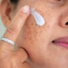 Mulher com melasma no rosto olhando para o espelho.