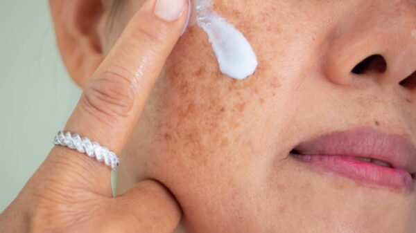 Mulher com melasma no rosto olhando para o espelho.