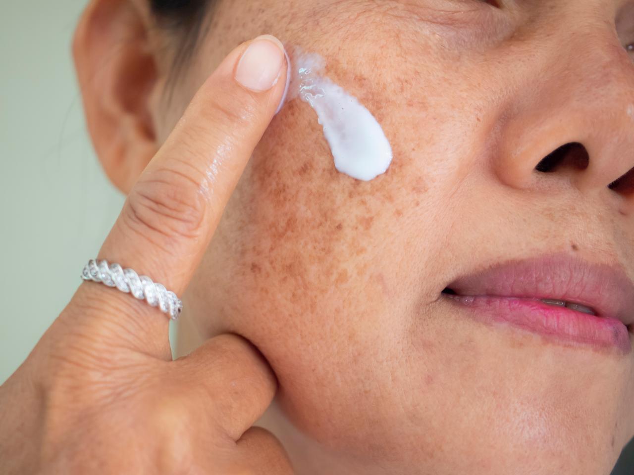 Mulher com melasma no rosto olhando para o espelho.