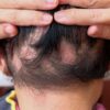 Foto mostra pessoa de costas com o cabelo cheio de quedas.