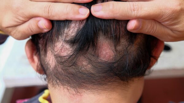 Foto mostra pessoa de costas com o cabelo cheio de quedas.