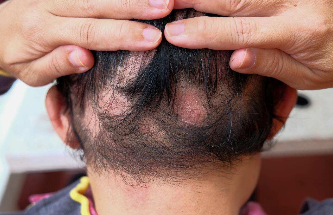 Foto mostra pessoa de costas com o cabelo cheio de quedas.