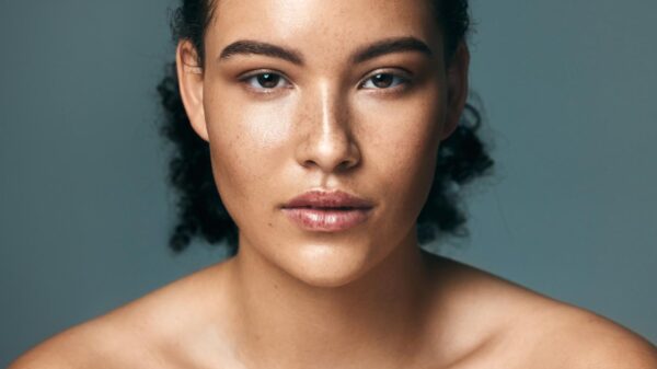 Melasma
