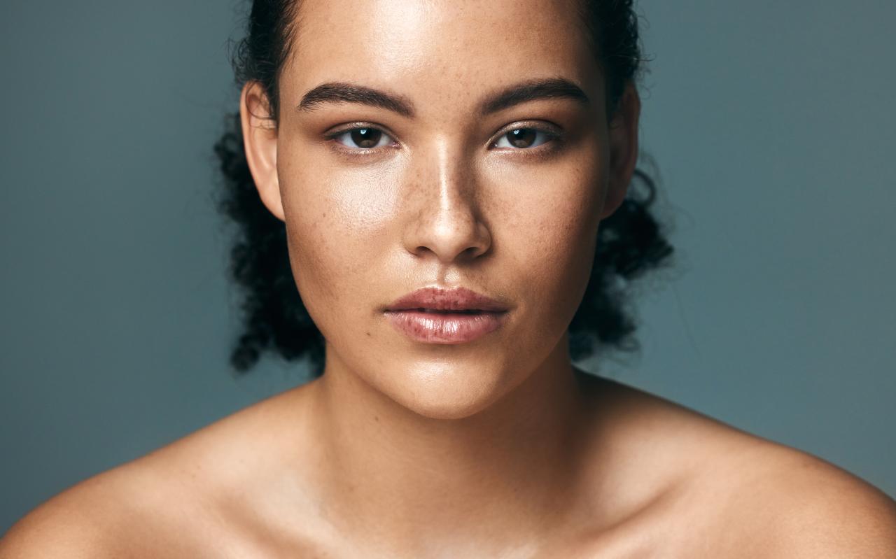 Melasma