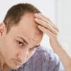 Minoxidil é usado no tratamento da queda de cabelo e deve ter orientação médica