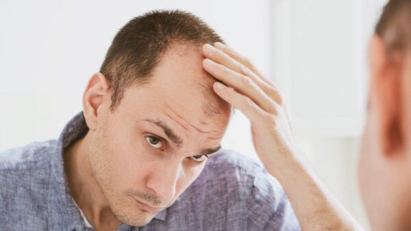 Minoxidil é usado no tratamento da queda de cabelo e deve ter orientação médica