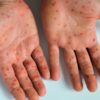 Imagem de uma mão com feridas de mpox