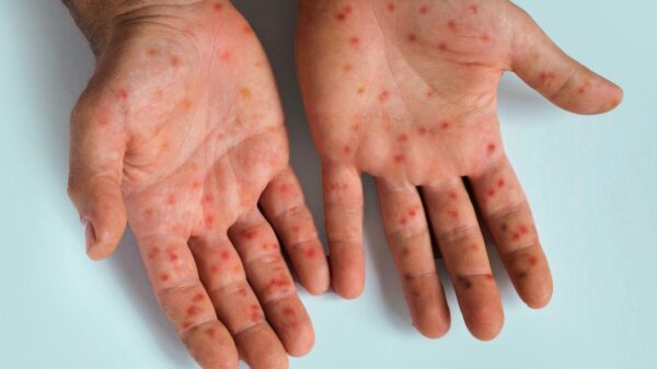 Imagem de uma mão com feridas de mpox