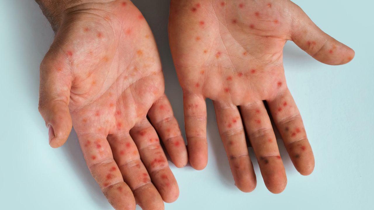 Imagem de uma mão com feridas de mpox