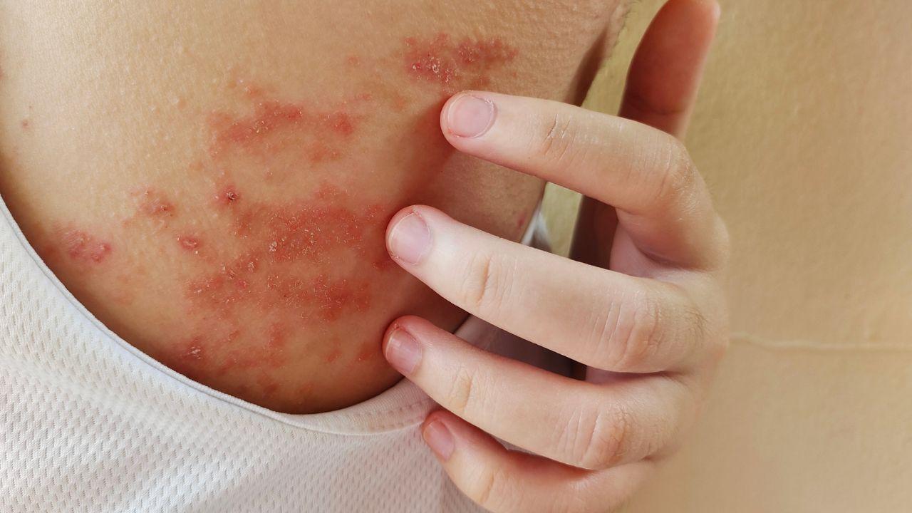 Imagem de uma pele com dermatite