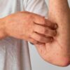 Por que algumas pessoas ficam com coceira após exercício ou banho quente?