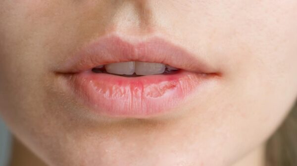 Boca seca frequente pode indicar alterações na produção de saliva