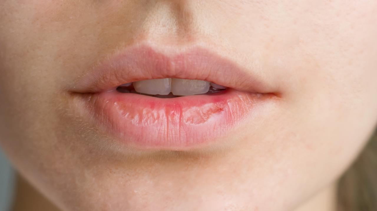 Boca seca frequente pode indicar alterações na produção de saliva