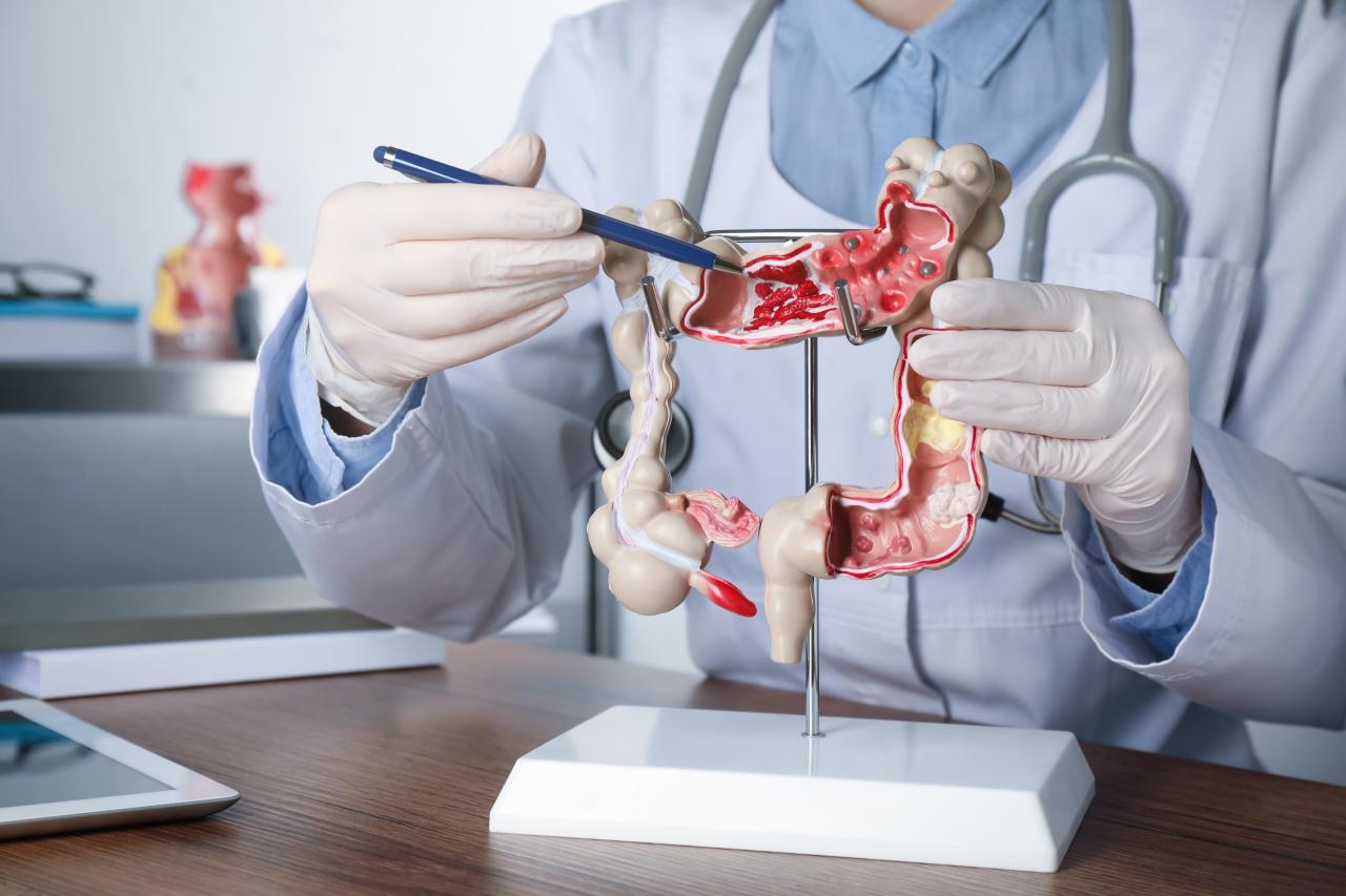 Câncer de intestino