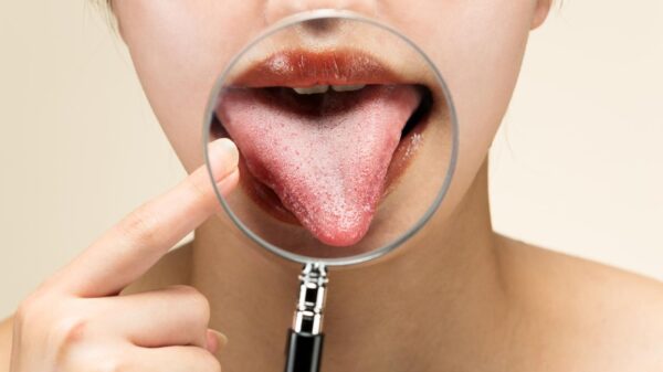 Língua branca ao acordar: é normal ou precisa de atenção?