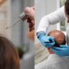 Minoxidil e implante capilar para combater a queda de cabelo