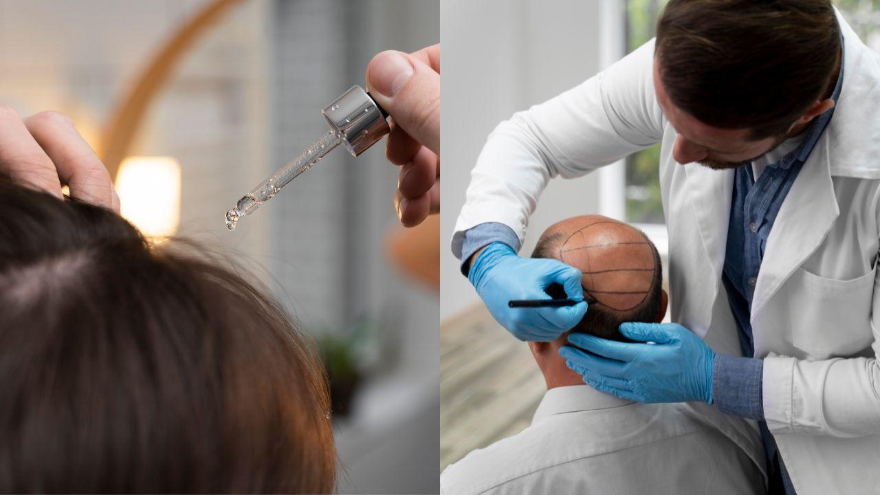Minoxidil e implante capilar para combater a queda de cabelo