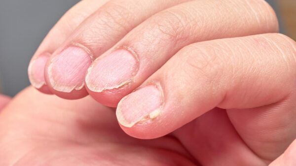 Mudanças nas unhas podem indicar carência de vitaminas e minerais