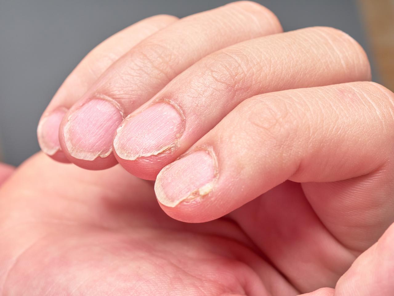 Mudanças nas unhas podem indicar carência de vitaminas e minerais