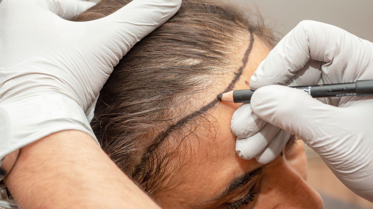Imagem de uma pessoa com a testa marcada para transplante capilar