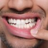 Boca seca, gengivas inflamadas e perda dentária podem ser sinais iniciais de diabetes