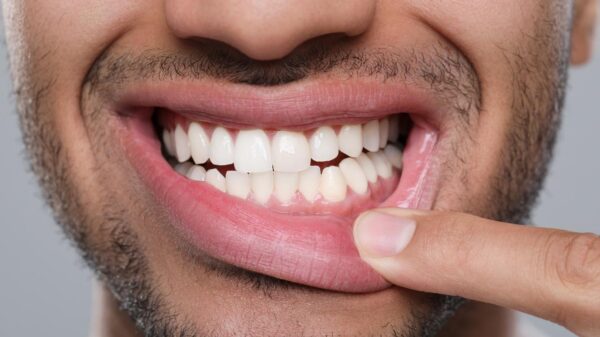 Boca seca, gengivas inflamadas e perda dentária podem ser sinais iniciais de diabetes