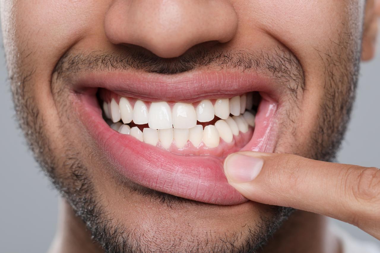 Boca seca, gengivas inflamadas e perda dentária podem ser sinais iniciais de diabetes