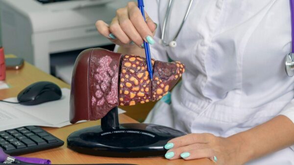 Imagem de uma médica apontando para uma peça de plástico de um fígado com gordura