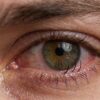 Triquíase: problema nos cílios pode causar irritação e desconforto ocular