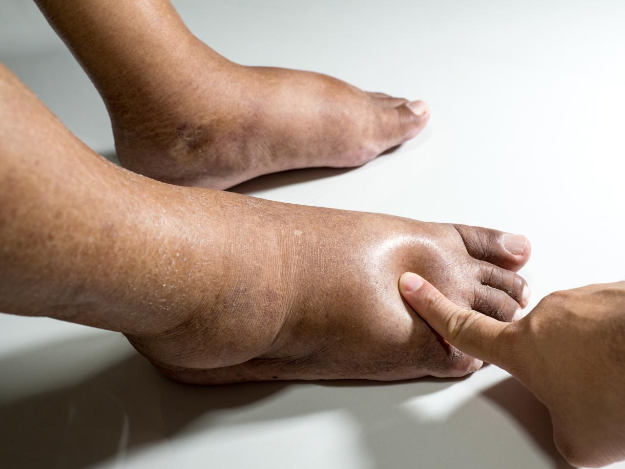 Foto mostra um pé muito inchado, sintoma comum do diabetes.