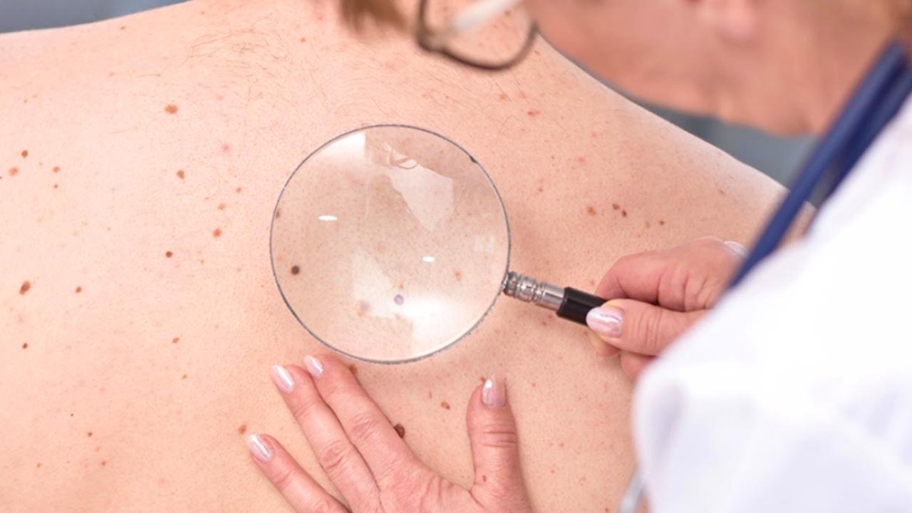 Câncer de pele: quando sinais aparentemente simples podem preocupar