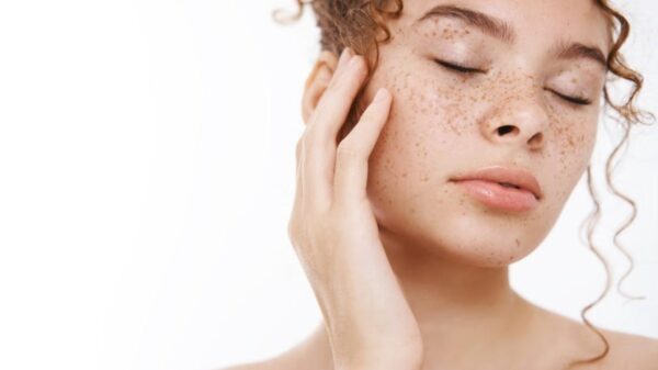 Mulher com melasma