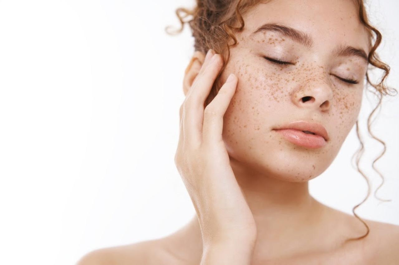 Mulher com melasma