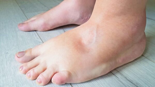Pés inchados: quando o sintoma pode ser sinal de alerta?